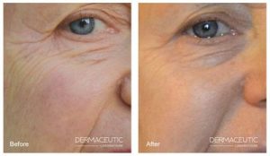 CosmoPeel1